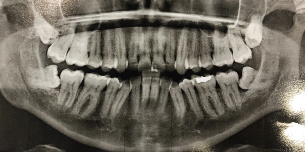 An image of a bite-wing dental x-ray