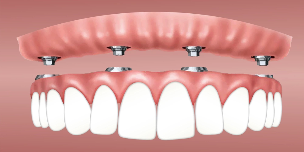 A graphic of a complete upper denture