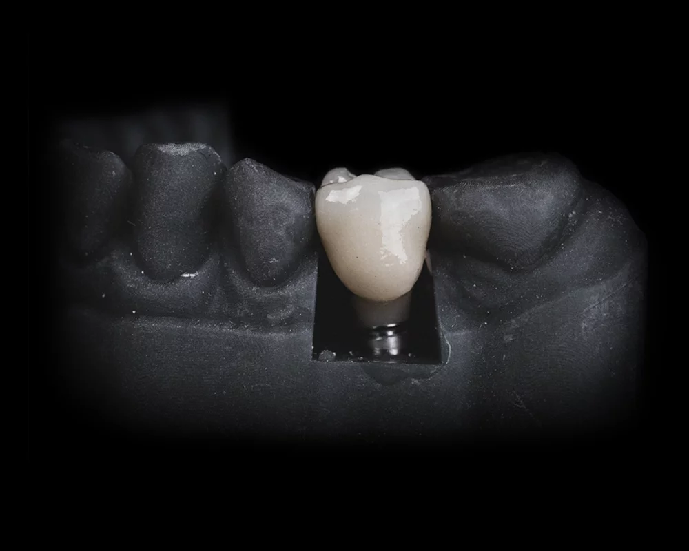 A model of a lower jaw and a dental implant replacing the gap in between the teeth
