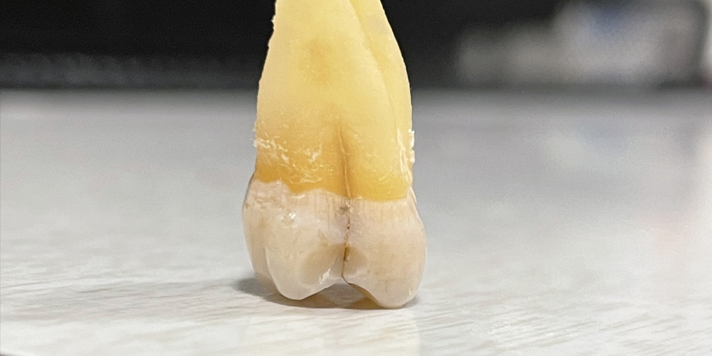 A molar standing up on a table on the crown showing a fracture through the crown and into the root