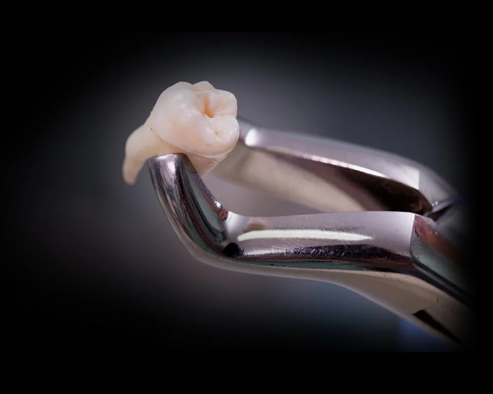 A molar being painlessly extracted by dental pliers 