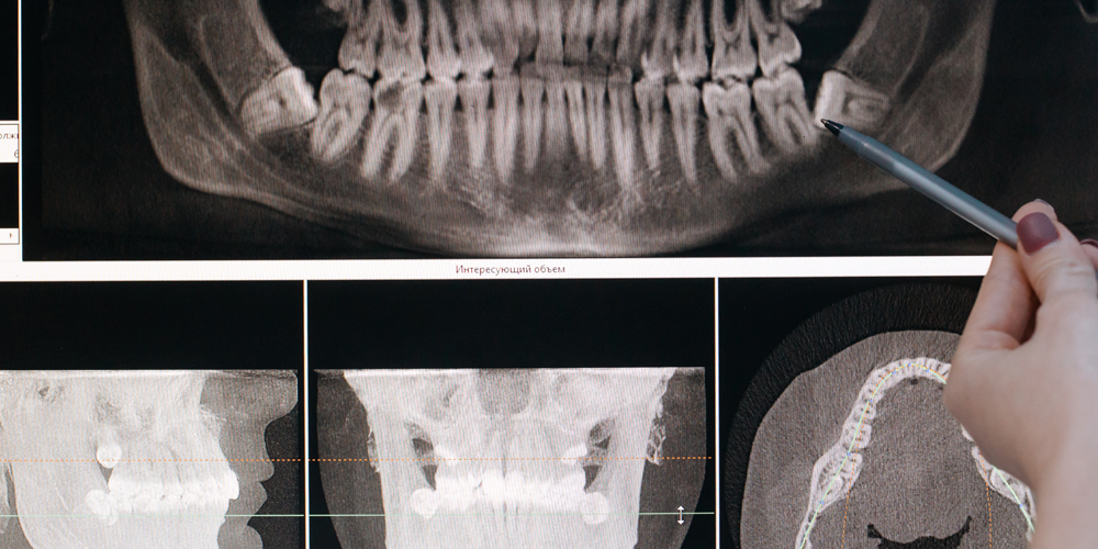 A dentist pointing out a wisdom tooth impacting other teeth on a panoramic dental x-ray