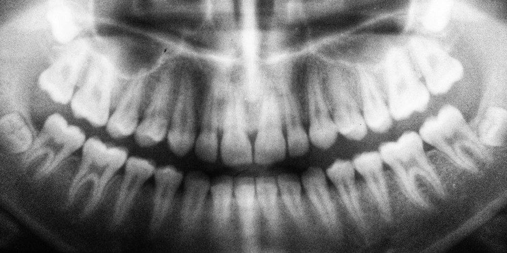 An image of a periapical dental x-ray