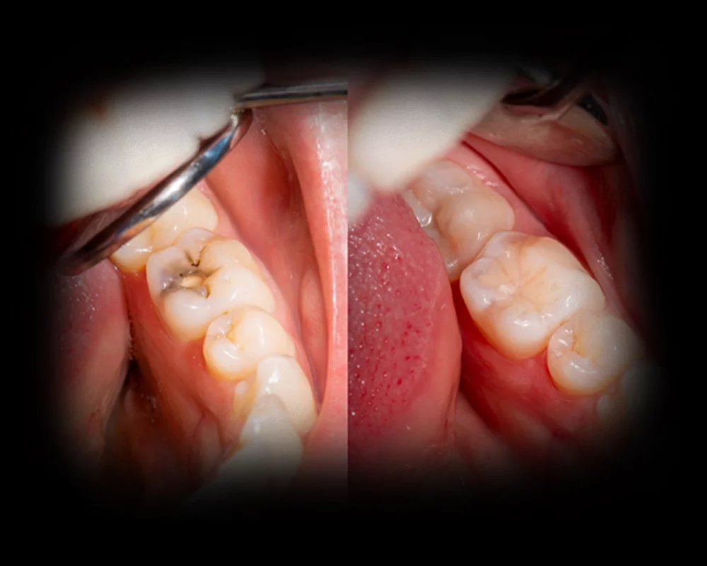A side by side images of a bad cavity in a molar and the cavity removed and filled without a trace