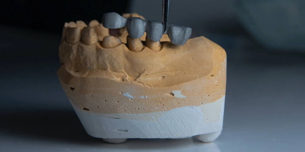 A model of a lower jaw being test fit with a dental bridge