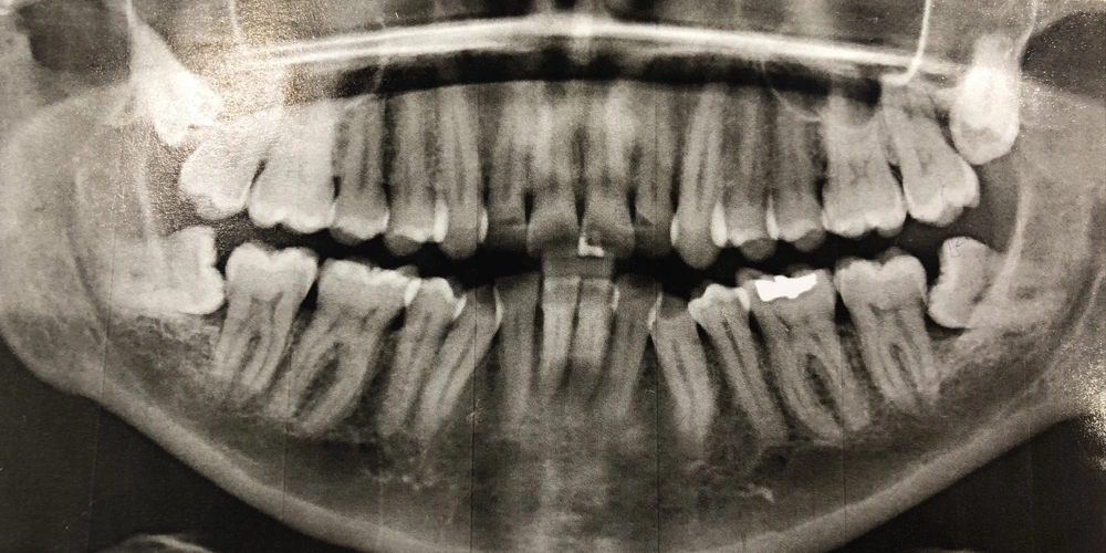 A radiograph showing the internal cleaning for a root canal