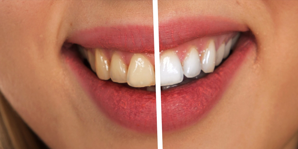 A side by side image of a women with yellow teeth before teeth whitening and white teeth after teeth whitening